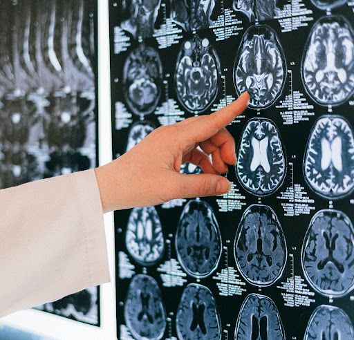 Medical Bed For Traumatic Brain Injuries (TBI)